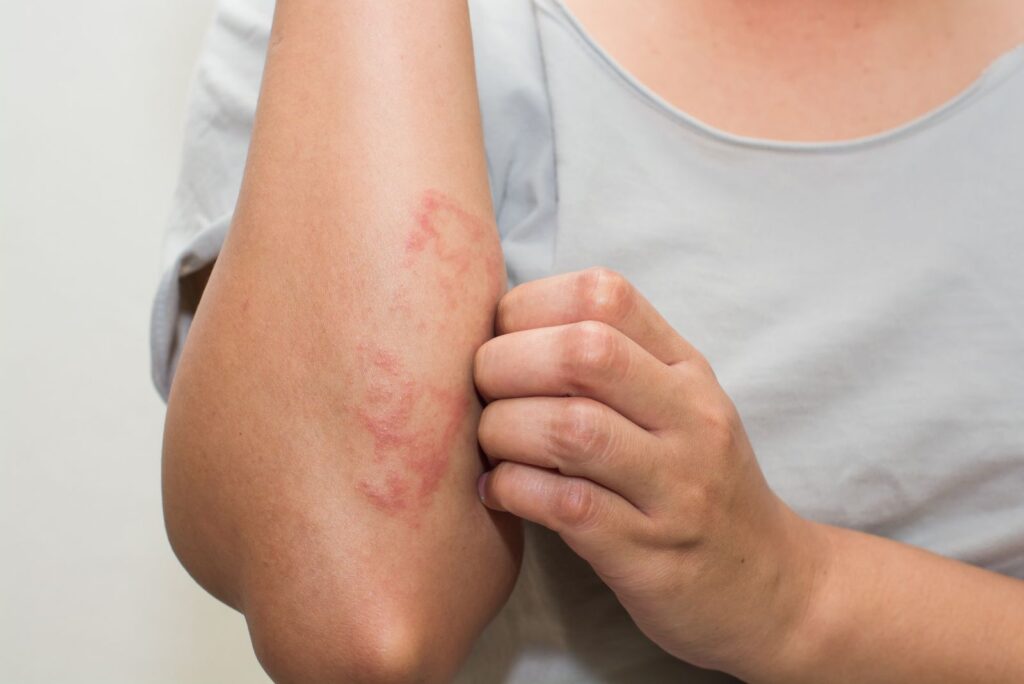 Eczema skin condition